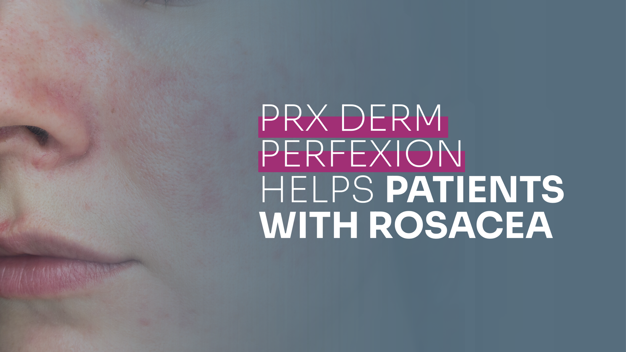 PRX Derm Perfexion Helps Patients With Rosacea