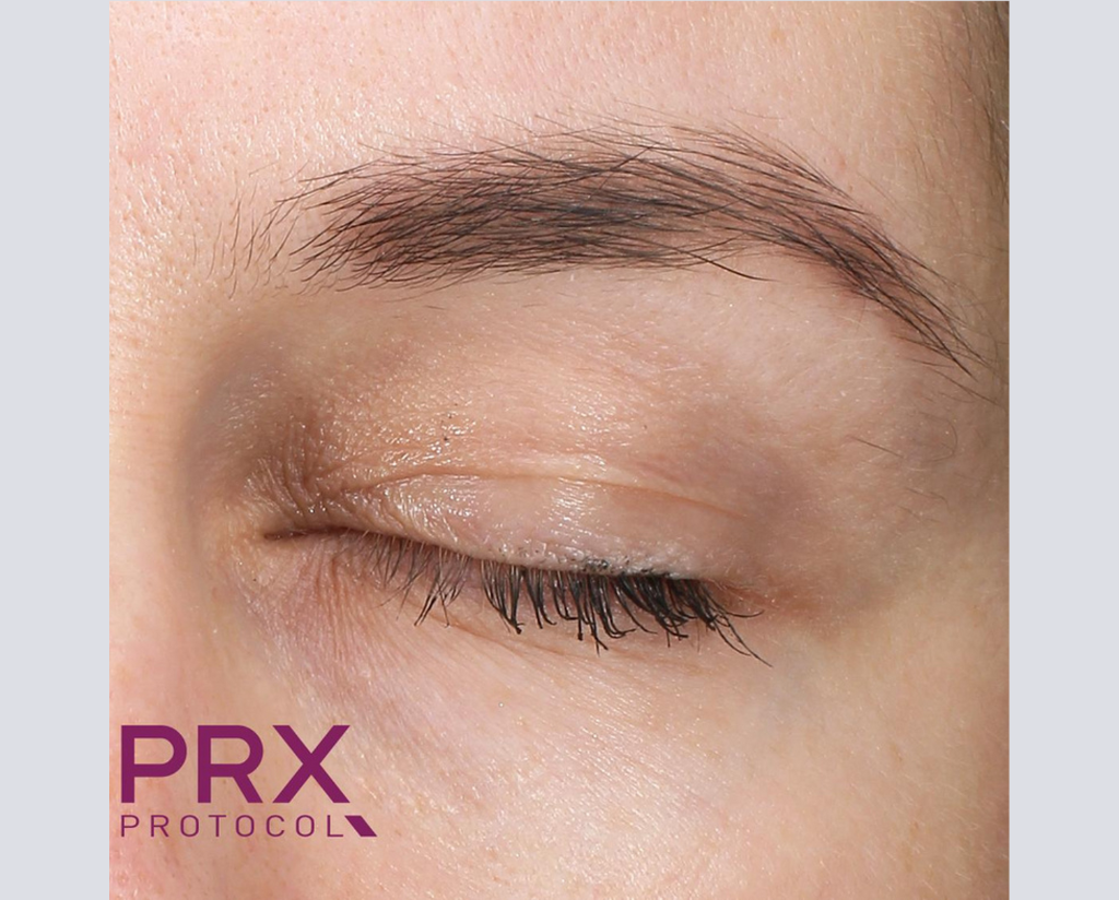 Prx Protocol PRX Derm Perfexion Before & After Gallery | WiQo US – WiQo® US, Inc.