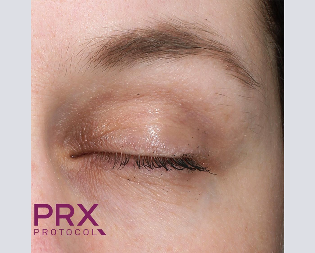 Prx Protocol PRX Derm Perfexion Before & After Gallery | WiQo US – WiQo® US, Inc.