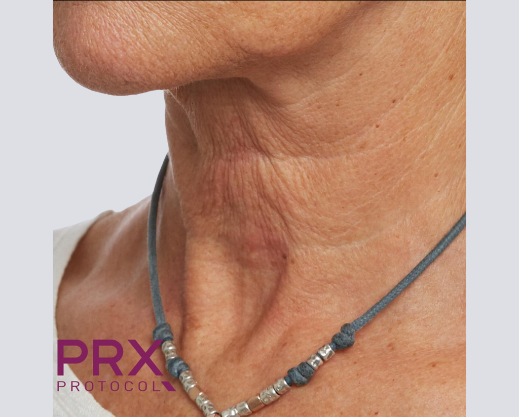 Prx Protocol PRX Derm Perfexion Before & After Gallery | WiQo US – WiQo® US, Inc.