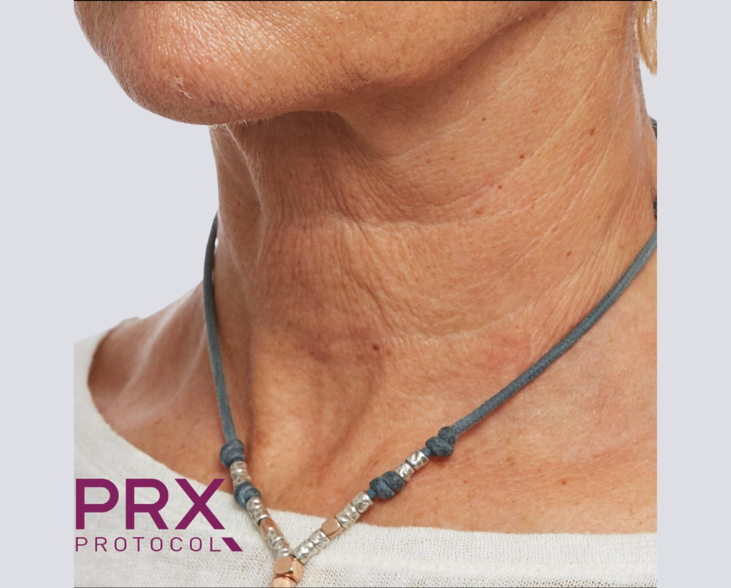 Prx Protocol PRX Derm Perfexion Before & After Gallery | WiQo US – WiQo® US, Inc.
