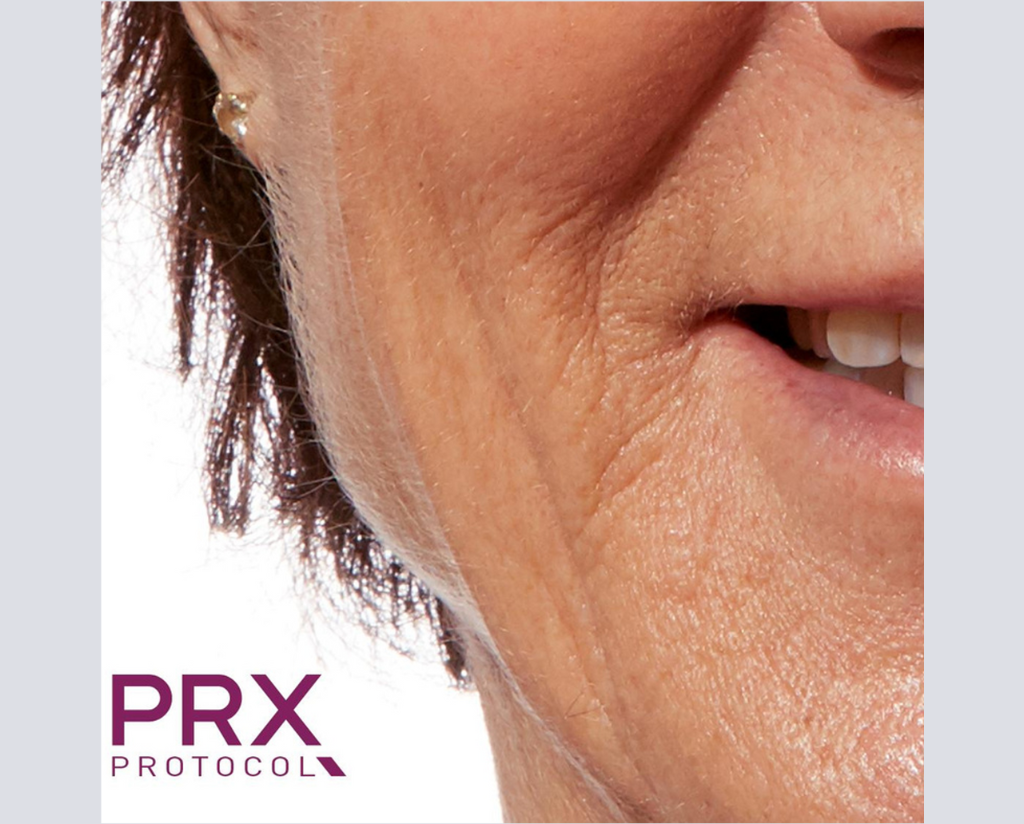 Prx Protocol PRX Derm Perfexion Before & After Gallery | WiQo US – WiQo® US, Inc.