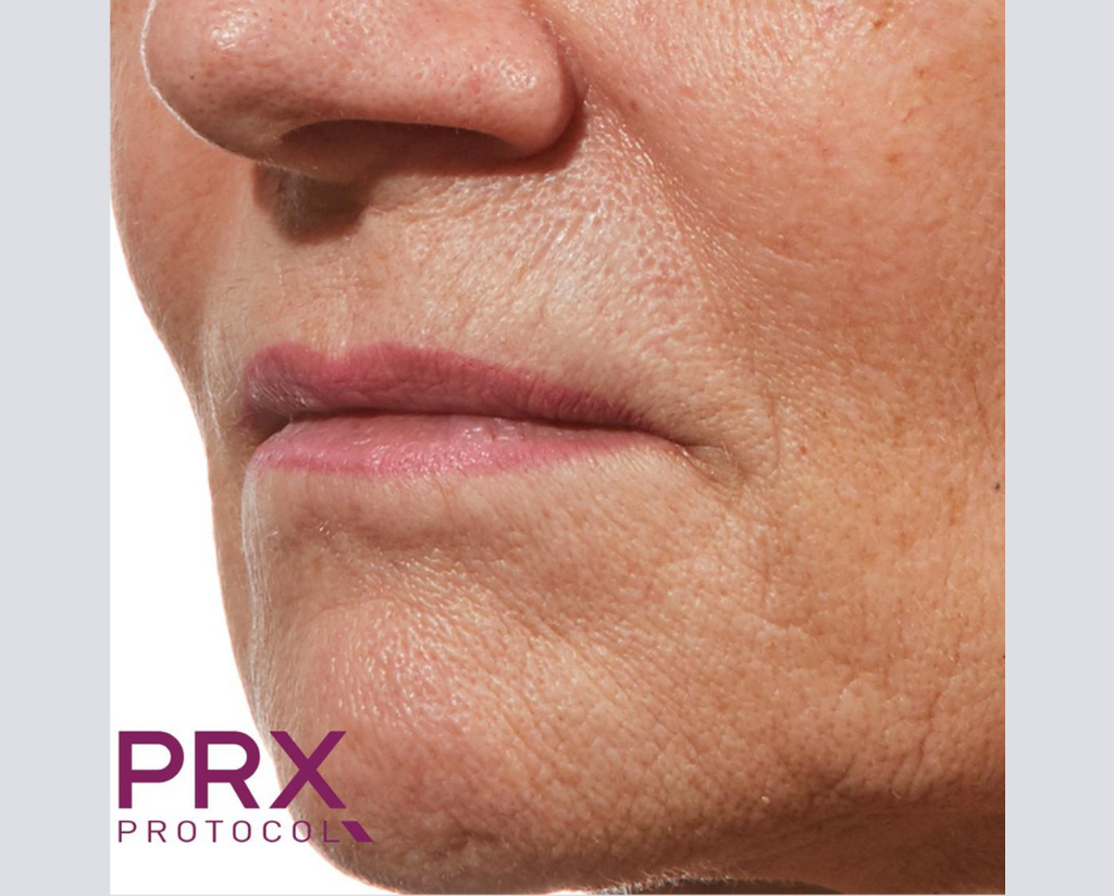 Prx Protocol PRX Derm Perfexion Before & After Gallery | WiQo US – WiQo® US, Inc.
