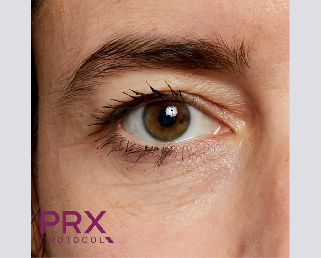 Prx Protocol PRX Derm Perfexion Before & After Gallery | WiQo US – WiQo® US, Inc.